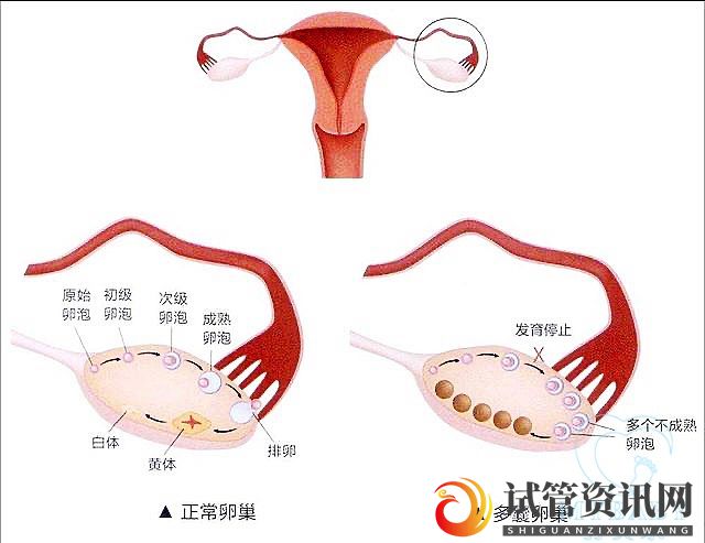 成都多囊卵巢综合症能做试管婴儿吗？成功率多少(图1)