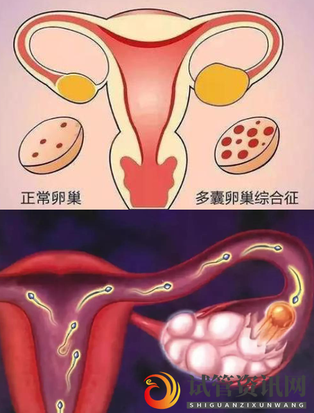 成都多囊卵巢综合症做试管婴儿要注意什么？(图1)