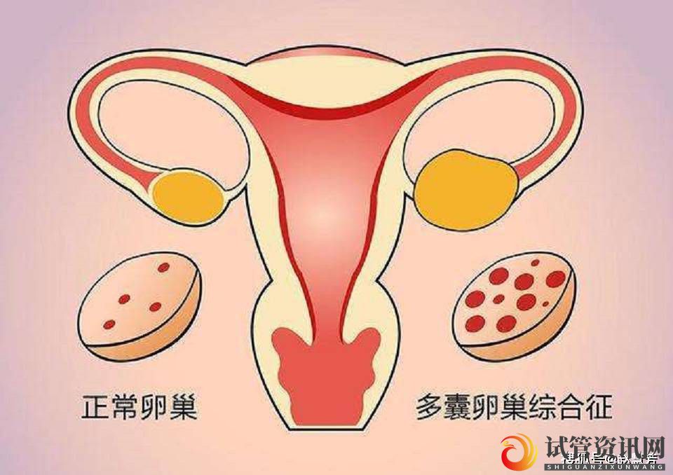 成都多囊卵巢综合症是怎么引起的？(图1)