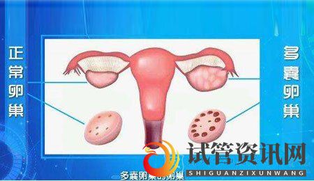 成都多囊卵巢能怀上孩子吗？卵巢多囊能自愈吗？(图1)