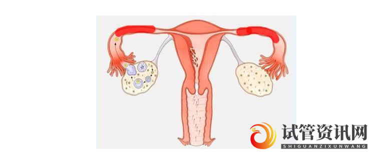 成都滋宫坊：月经絮乱不规律，卵巢有很多泡泡，是囊卵巢综合征的表现，多囊卵巢综合征怎么治疗？(图1)