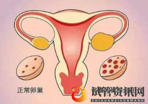 多囊卵巢综合征对试管婴儿有什么影响(图1)