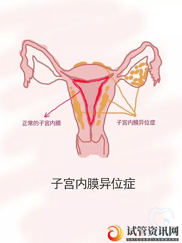 成都子宫内膜异位症试管婴儿成功率高吗？(图1)