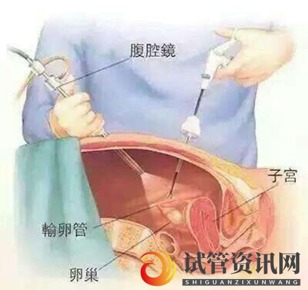 成都曾被诊断输卵管通而不畅,1个月逆转成功怀孕(图6)