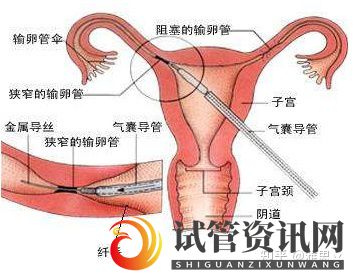成都输卵管不畅做试管婴儿助孕一定会成功吗(图1)