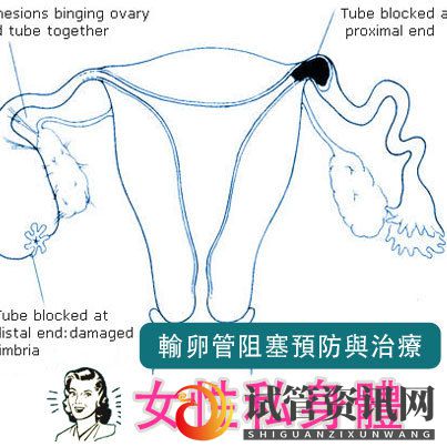 成都输卵管堵塞,怀孕到底有多难__知乎_(图4)