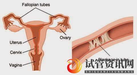成都输卵管堵塞,怀孕到底有多难__知乎_(图5)