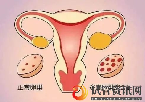 多囊卵巢女性如何备孕(图1)