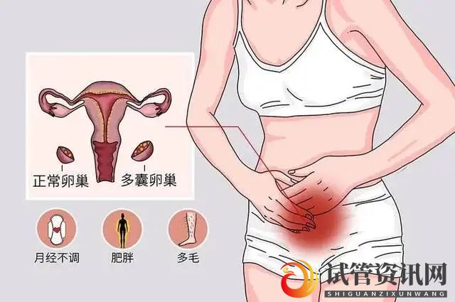 多囊卵巢综合征的临床表现？(图1)