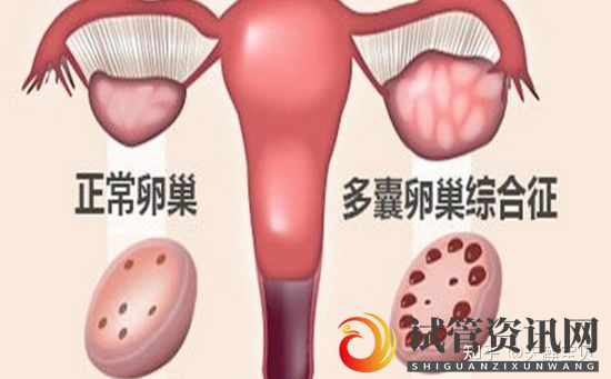 什么是多囊卵巢_多囊卵巢可以做试管吗(图1)